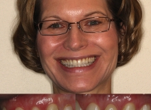 Veneers