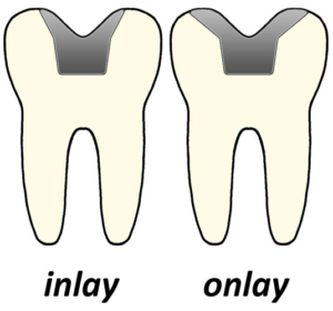 inlayonlay